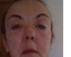 facelift alternative with heart condition