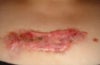 keloid needing removal