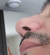 Septorhinoplasty scar