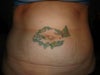 Tattoo removal tummy tuck
