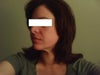 loose neck skin with sculptra?