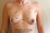 natural slope and cleavage from breast implants