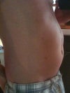 I am a 36, male and I have had diastatis recti