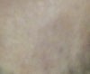 Dettol on my face skin