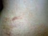 I'm an Asian and I learned that Asians tend to develop keloid and hypertrophic scars.