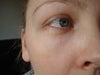wrinkling under my eyes following laser surgery