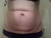 old surgery scar