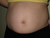 Which non-surgical/non-invasive procedure is best for me? VelaShape or Thermage or something else?