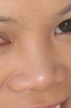 flat nose surgery