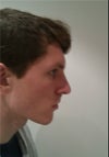 My nose before operation