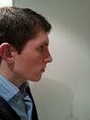 A couple of hours after splint removal (9 days post op). Nose is quite a bit smaller here and tip is less rounded and swollen.