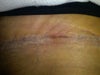 The area of concern is approx. 3 inches in length - raised and swollen.