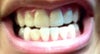 The (42) lower right lateral incisor is not done yet