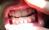 The (42) lower right lateral incisor is not done yet