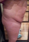 Side View (sagging bulge)