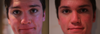 After front view. You can see how the lighting affects how my nose looks. On the left photo, it isn't as apparent that my nose is raised up, but you can tell that the right side of my nostril goes way out to the side more. On the right photo, you can actually see how big my nose looks. and on both you can see how uneven my nostrils now are.