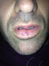 Lower lip is now uneven.