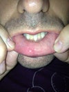 Inside lip is hard scar tissue.