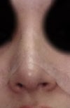 after front view...very off center and one side nostrils look more pushed in the the other