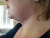 10 days after neck lipo.