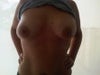 385cc teardrop high profile Brazilian implantS