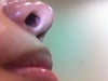 Keloid isit normal? Or danger?