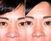 Eye Bags Treatment before & after photos
