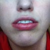 My lips do not close at rest
