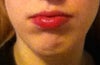 Forcing my lips closed causes mentalis strain