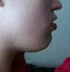 From the side my lip incompetency is terrible looking
