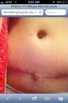 Bump on scar