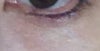 My left eye. Even though the inner portion of the bottom lids touch the edge of the iris, why is there so much "flesh" show on top on the lids?
