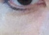 My right eye. Not as bad as the left. Does this look like normal healing?