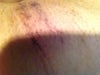 The marks after my IPL treatment
