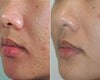 Acne scars