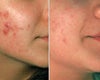 Acne surgery before & after photos