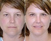 Active FX before & after photos