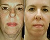 Affirm laser before & after photos