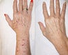 Age Spots