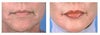AlloDerm before & after photos