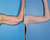 Arm lift before & after photos