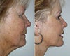 Dermabrasion before & after photos