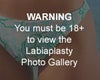 Labiaplasty before & after photos