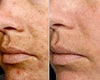 Melasma