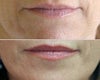 Silicone injections before & after photos