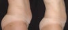 Body Jet before & after photos
