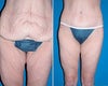 Body lift before & after photos