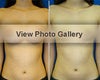 Breast implant removal before & after photos