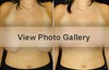 Breast lift before & after photos