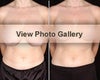 Breast reduction before & after photos